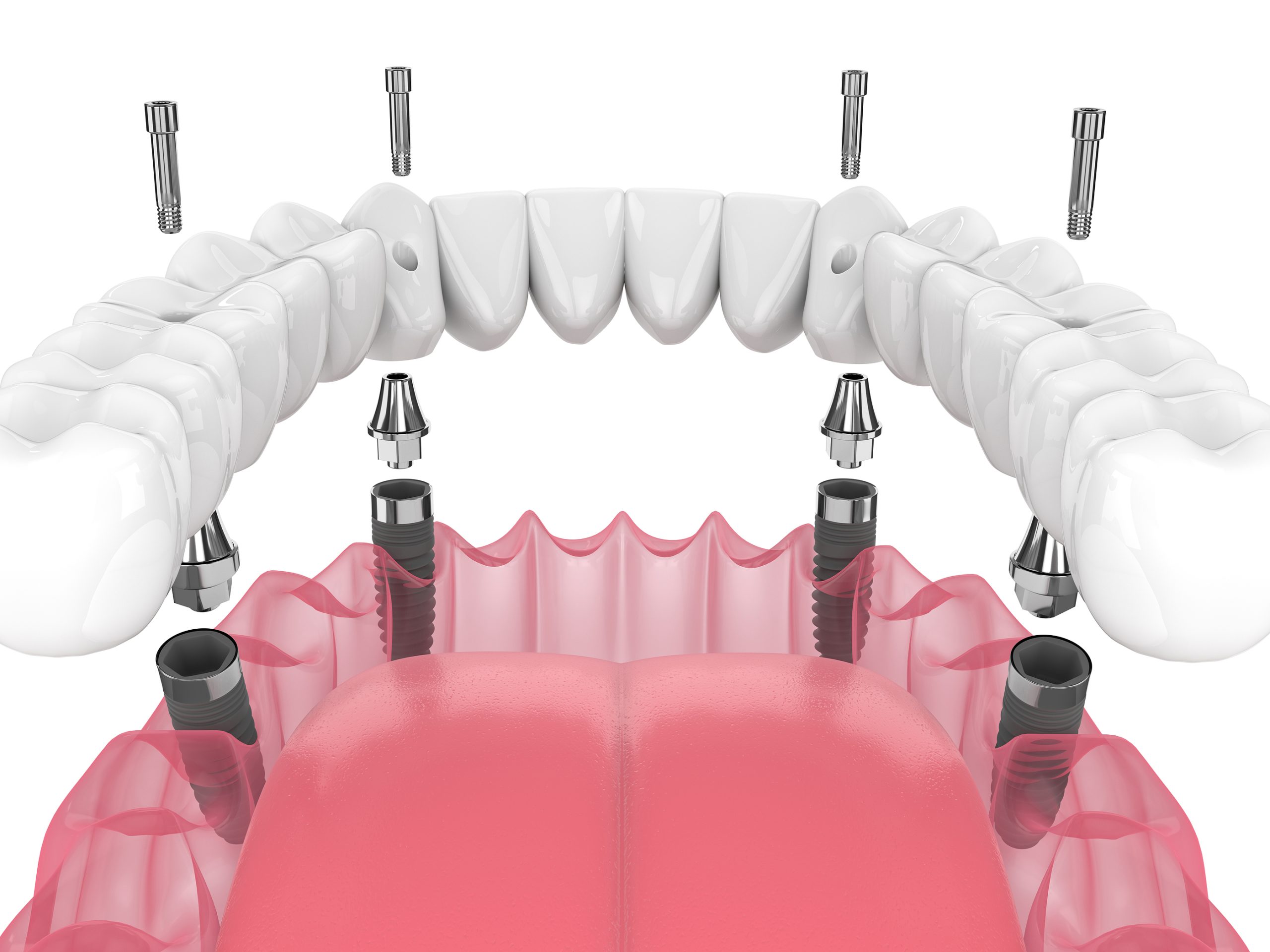 The Transformative Benefits of All-on-4 Implants in Alexandria, VA