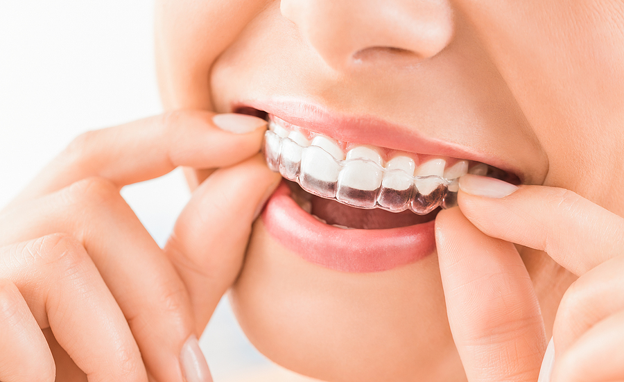 Achieving a Perfect Smile with an Invisalign Dentist in Alexandria, VA
